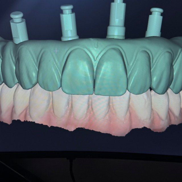 Próteses sobre Implantes — Protocolos, barras e supraestruturas sobre implantes dentários com fluxo digital guiado.