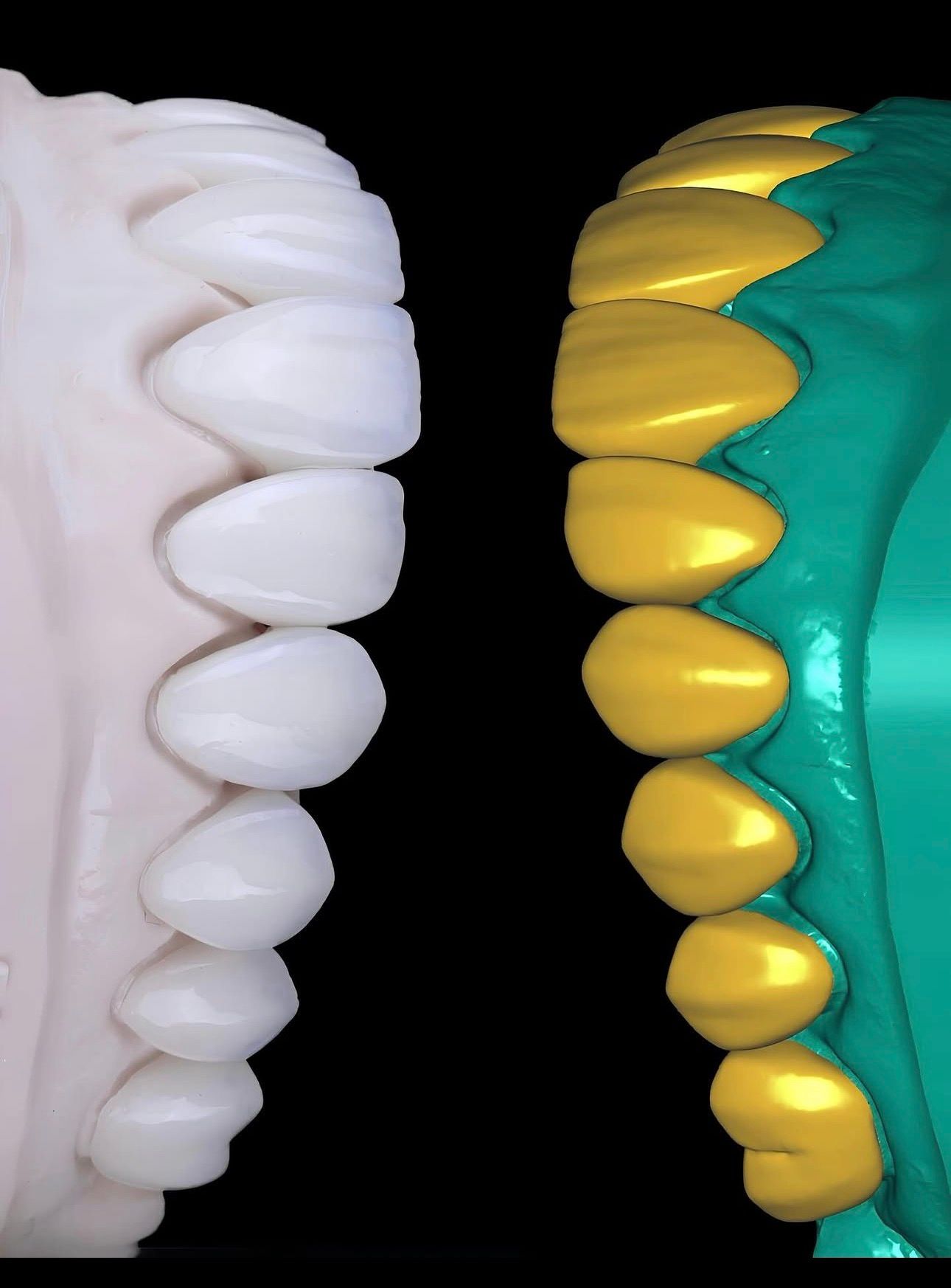 Fresagem CAD/CAM odontológico de prótese dentária
